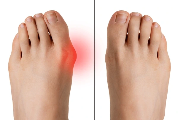 bunion correction near you
