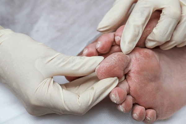 diabetic foot care in largo