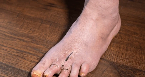 hammertoe correction in largo