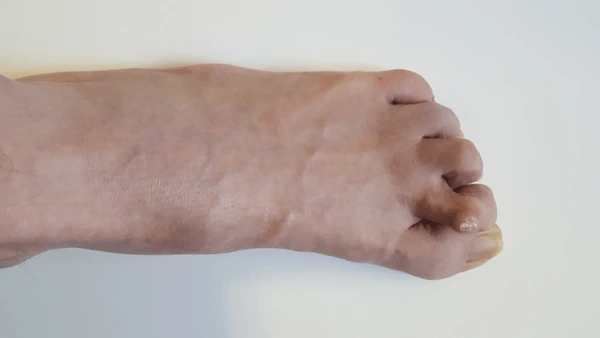 hammertoe correction near you