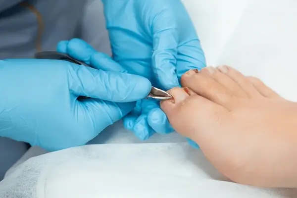 ingrown toenail treatment in largo