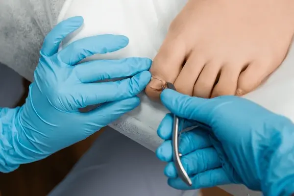 ingrown toenail treatment near you