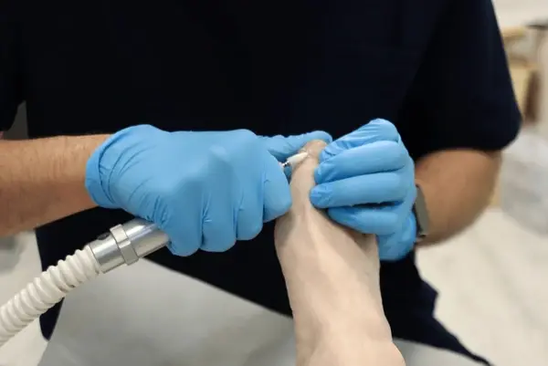 toenail fungus treatment in largo