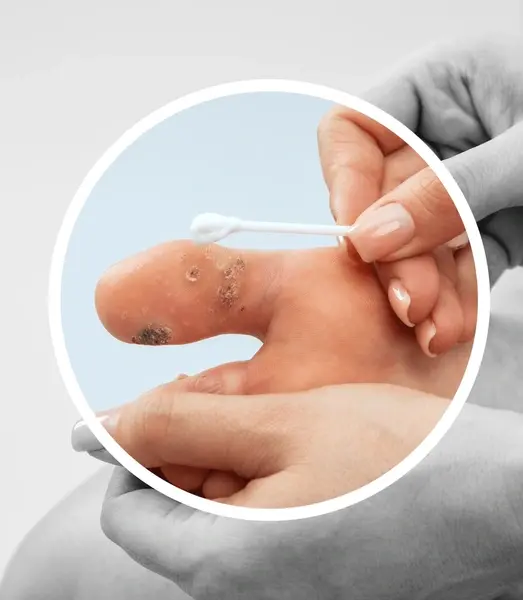 warts treatment near you